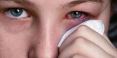 تهدئة حساسية الأنف والعيون بعلاجات طبيعية