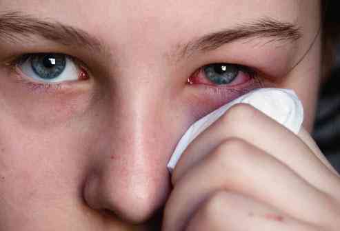 تهدئة حساسية الأنف والعيون بعلاجات طبيعية