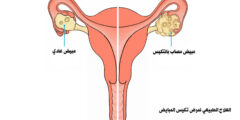 علاج ارتفاع هرمون التستوستيرون عند النساء