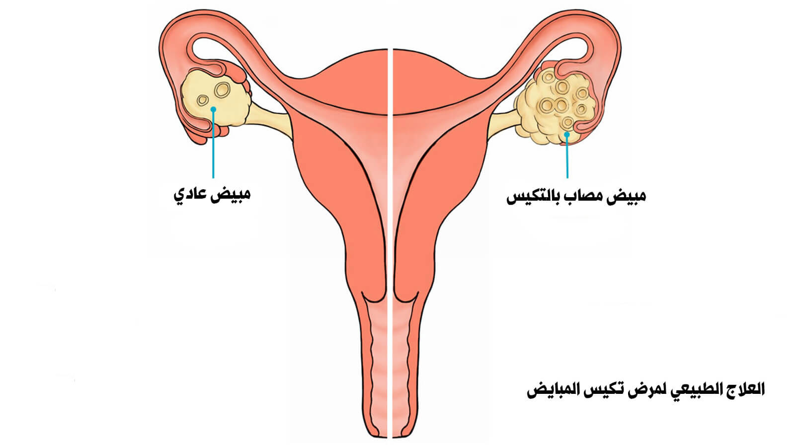 أعراض زيادة هرمون الأنوثة عند النساء